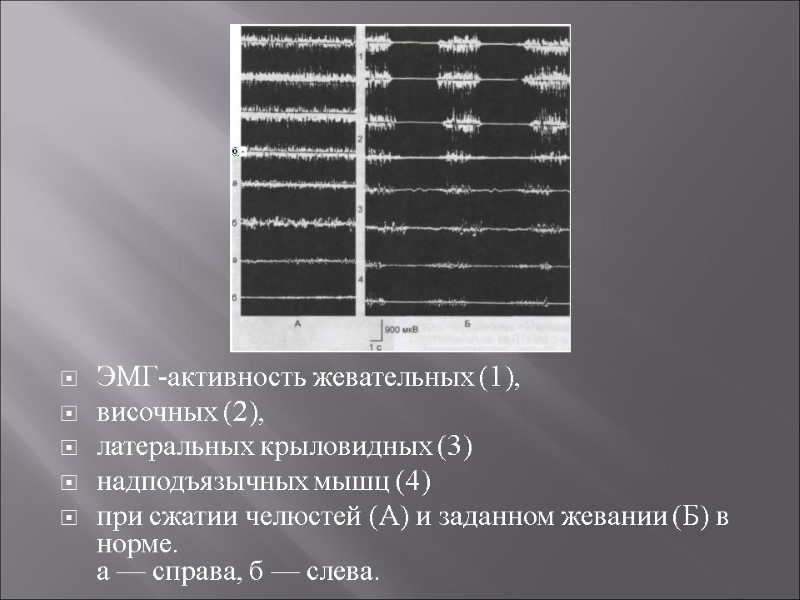 ЭМГ-активность жевательных (1),  височных (2),  латеральных крыловидных (3)  надподъязычных мышц (4)